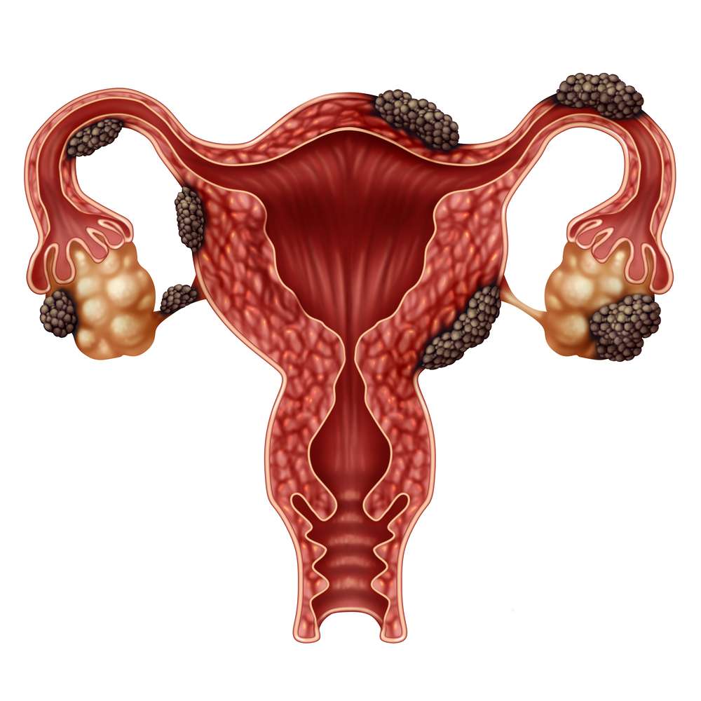 Endometriose fachgutachten schaden trauma protokoll fallbeispiele